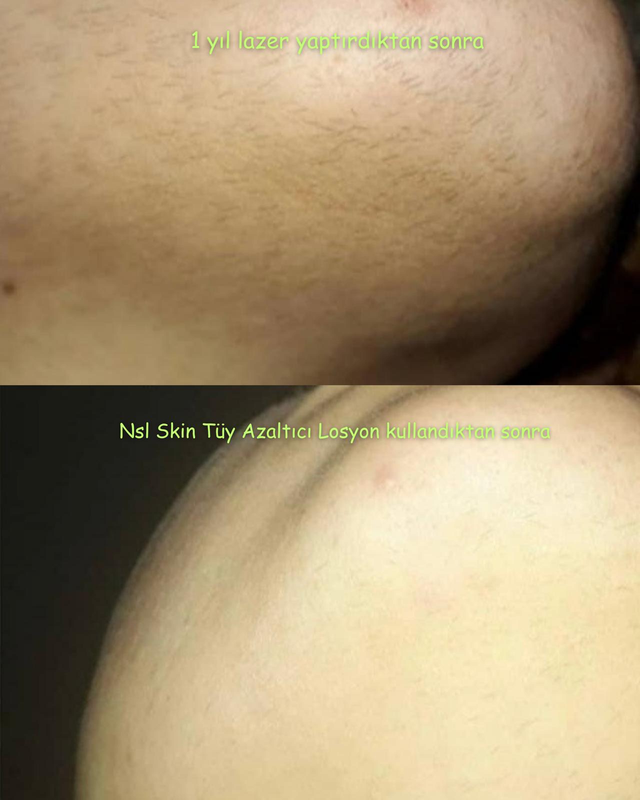 Lazer Etkili Tüy Azaltıcı Losyon